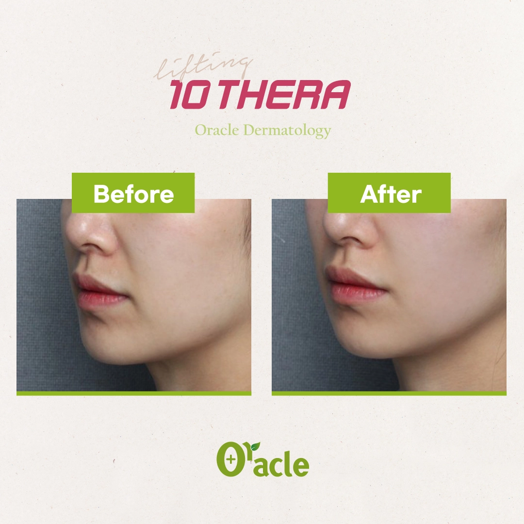 10Thera